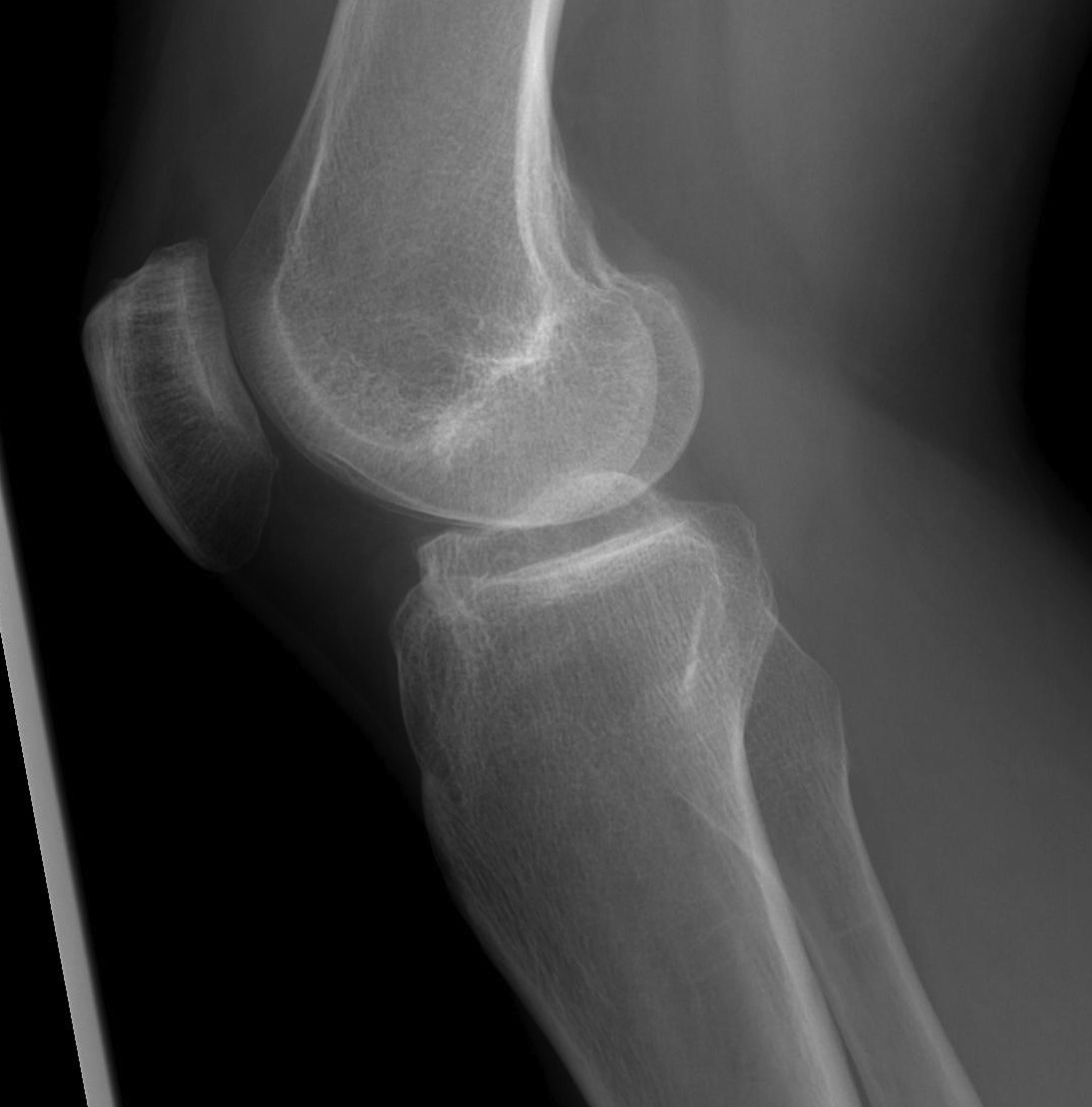 ACL Avulsion Malunion